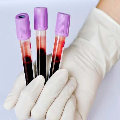 hemato4 Blood sample