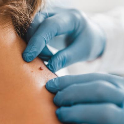 Close up of dermatologist examining patient birthmark in clinic
